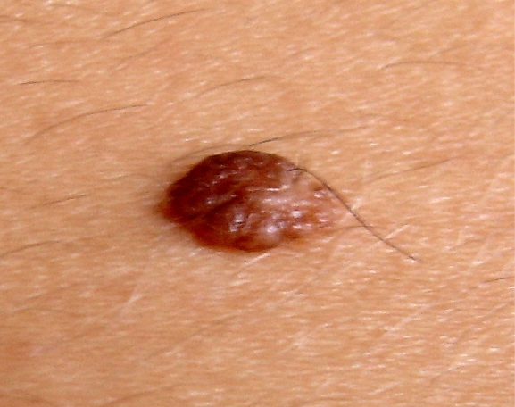 dermnaevus