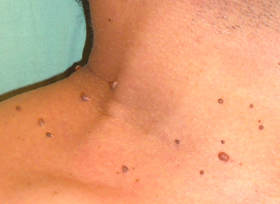 fibromatacolli