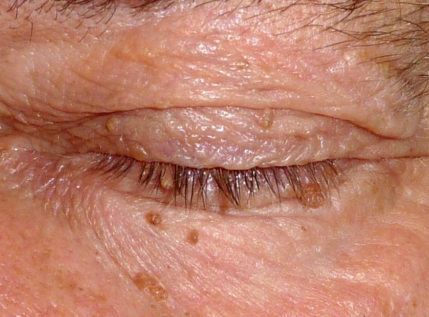lidfibrome