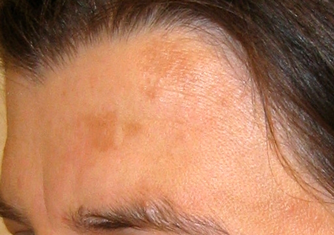melasma