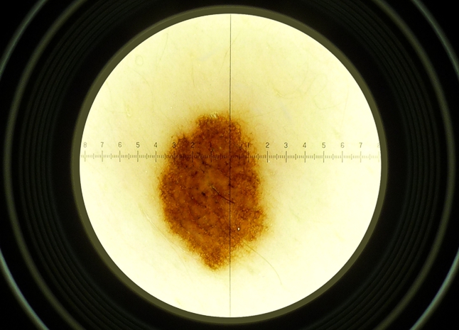 naevusdermatoskop0687_small_neu