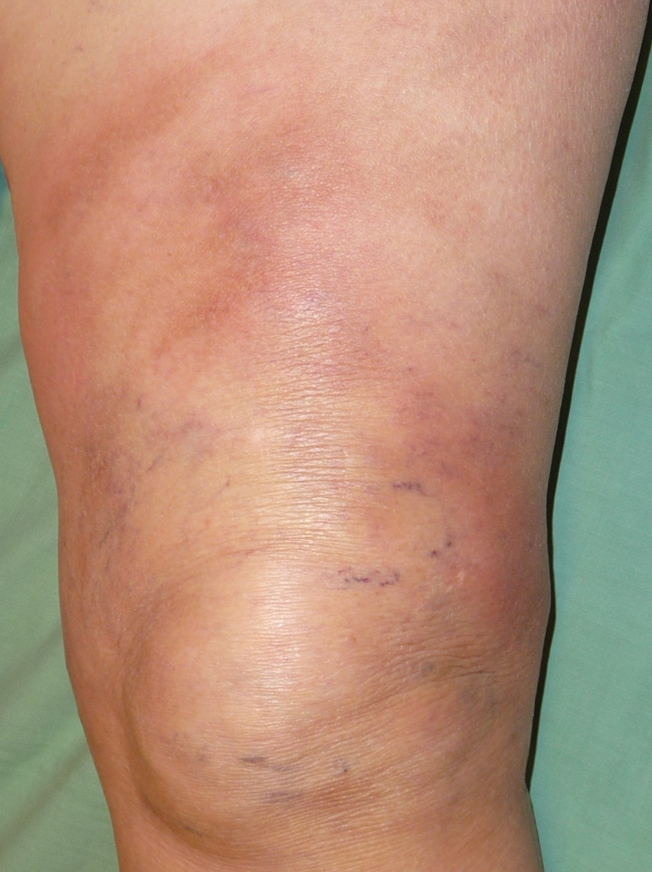 thrombophlebitis