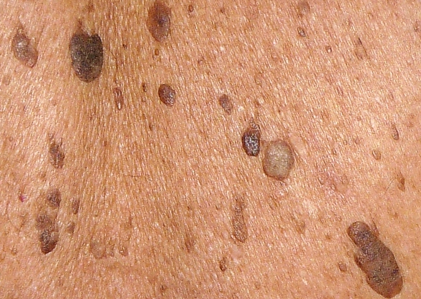 verrucaeseb